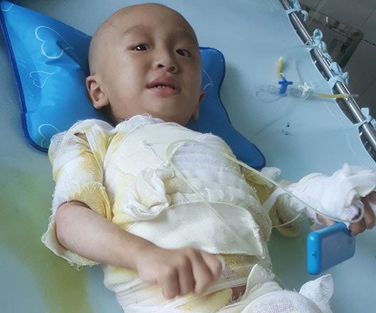 Đau đớn bé trai 18 tháng tuổi bị bỏng toàn thân vì ngã vào nồi nước nóng ở đám cưới-2