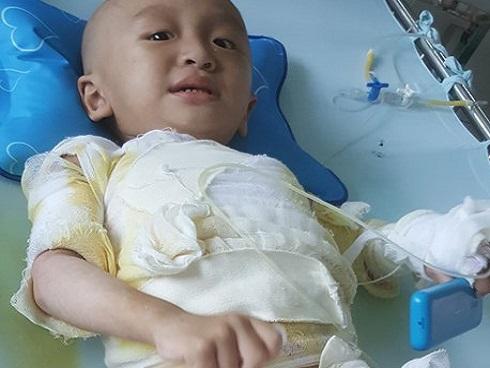 Bé gái 2 tuổi bị bỏng toàn bộ miệng vì ăn nhầm gói tẩy lồng máy giặt-3