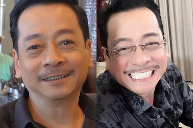 Dán răng sứ: Tưởng an toàn vì chẳng cần mài bọc răng vẫn trắng đẹp, nhưng không phải ai cũng làm được-1