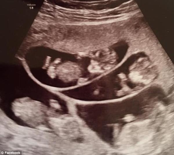 Đang cố thụ thai đứa con thứ 4, bà mẹ choáng váng khi mang bầu một lúc 6 thai-2