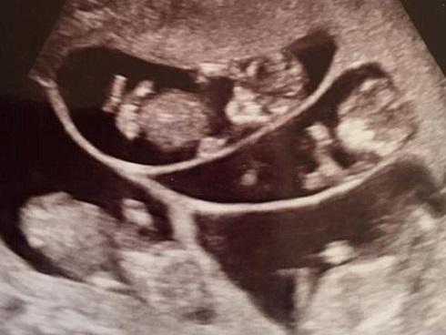 Đang cố thụ thai đứa con thứ 4, bà mẹ choáng váng khi mang bầu một lúc 6 thai