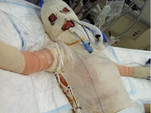 Ký ức kinh hoàng của cô gái bị người lạ thiêu sống như ngọn đuốc vì đánh ghen nhầm