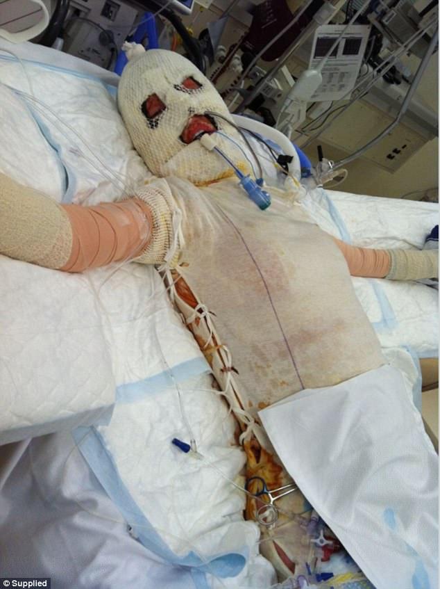 Ký ức kinh hoàng của cô gái bị người lạ thiêu sống như ngọn đuốc vì đánh ghen nhầm-2