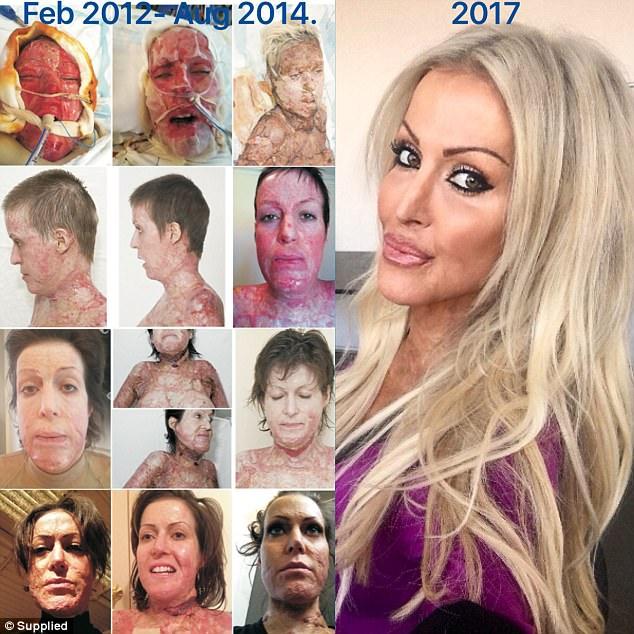 Ký ức kinh hoàng của cô gái bị người lạ thiêu sống như ngọn đuốc vì đánh ghen nhầm-4