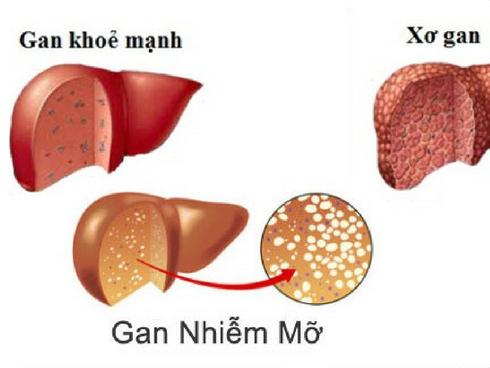 Nóng gan, chớ xem thường