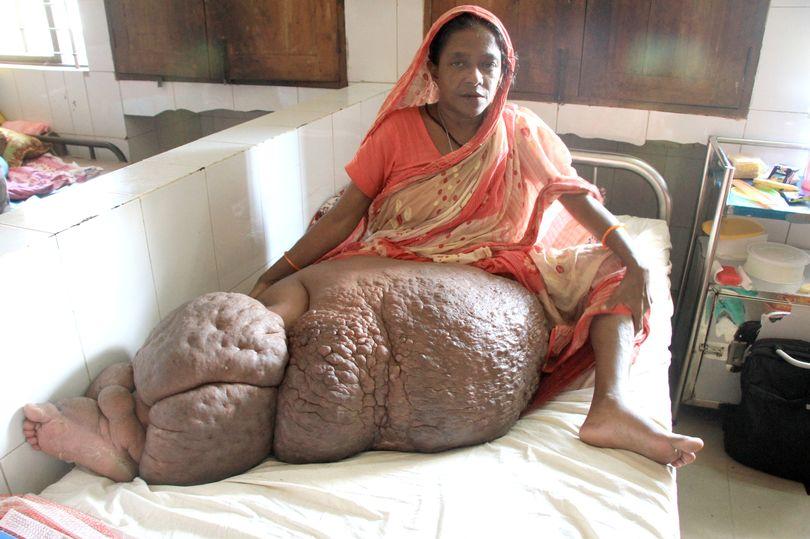 Người phụ nữ mang chiếc chân voi nặng hơn 60 kg-1