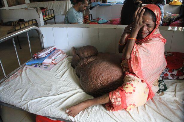 Người phụ nữ mang chiếc chân voi nặng hơn 60 kg-2