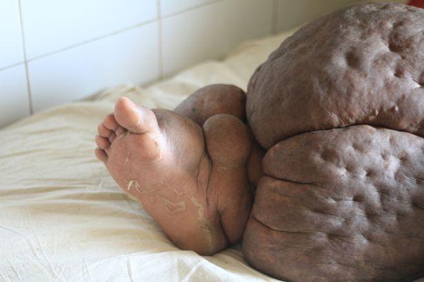 Người phụ nữ mang chiếc chân voi nặng hơn 60 kg-4