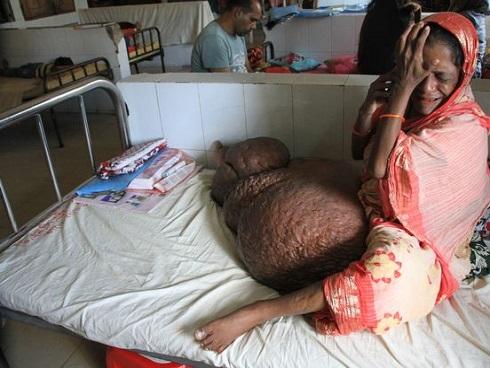 Người phụ nữ mang chiếc 'chân voi' nặng hơn 60 kg