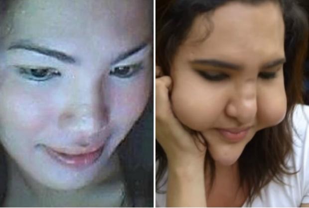 3 cô bạn thân người Philippines cùng biến dạng mặt vì tiêm filler giá rẻ-2