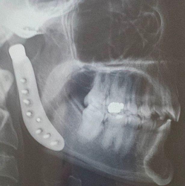 Cảnh báo căn bệnh nguy hiểm từ bà mẹ trẻ bị liệt cơ hàm chỉ sau một đêm-5