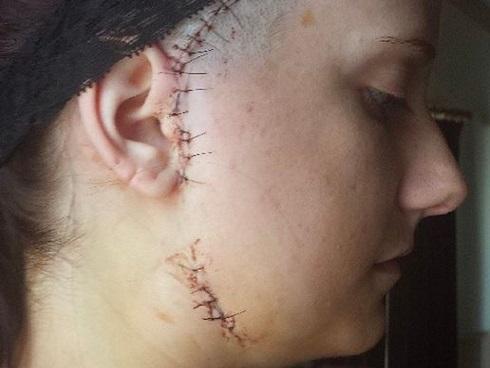 Đú đởn xăm nhãn cầu, cô gái trẻ khóc uất nghẹn vì biến chứng mù mắt-5