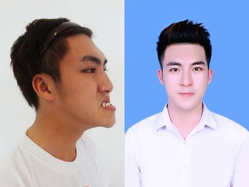 Sốc: Chàng trai Quảng Ninh mặt lưỡi liềm giờ đây đẹp như hotboy xứ Hàn