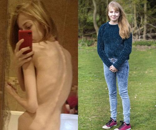 5 cô gái trẻ xinh đẹp hóa bộ xương khô vì giảm cân quá mức-7