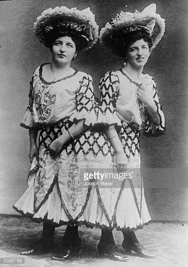 Chuyện ly kỳ về đời sống tình dục của cặp song sinh dính liền nổi tiếng lịch sử-1