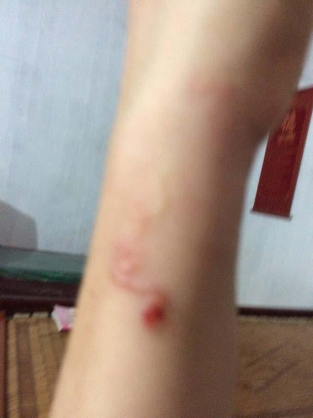 Hà Nội: Người phụ nữ thất thần khi phát hiện ấu trùng bò lổm ngổm dưới da-1