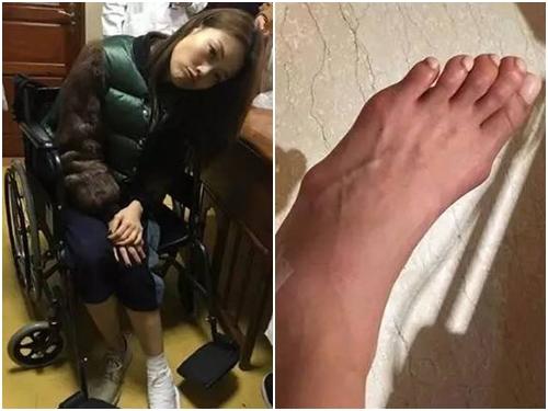 Siêu sao Hoa Ngữ biến dạng bàn chân vì sở thích đi giày cao gót quái chiêu