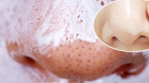 Cách trị mụn cám, mụn đầu đen với kem đánh răng siêu đơn giản-6