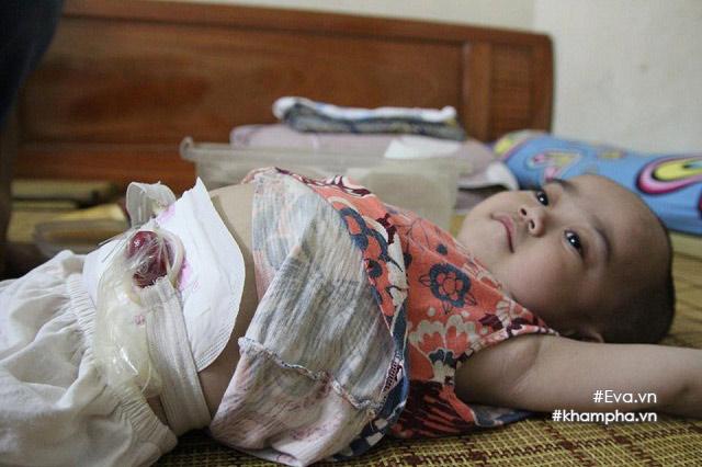 Em bé đi bằng 4 chân, sống nhờ vào những chiếc bao cao su và băng vệ sinh-2