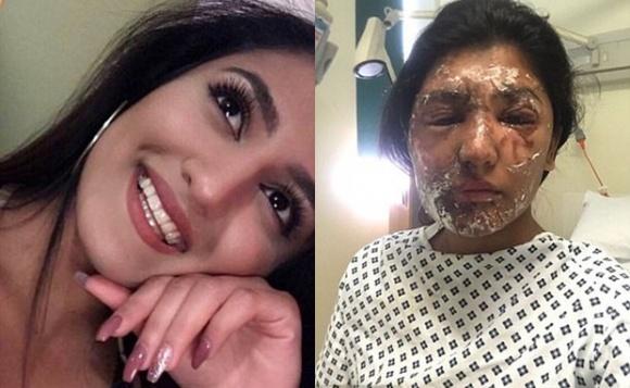 Hình ảnh mới sau khi tái tạo da của nữ sinh viên Anh bị tạt axit gây bất ngờ-1