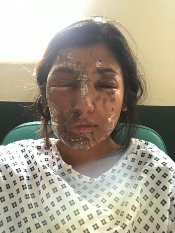 Hình ảnh mới sau khi tái tạo da của nữ sinh viên Anh bị tạt axit gây bất ngờ-2