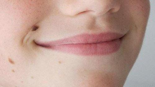 Trị mụn ruồi xấu xí với công thức đơn giản chưa đến 2 ngàn đồng-4