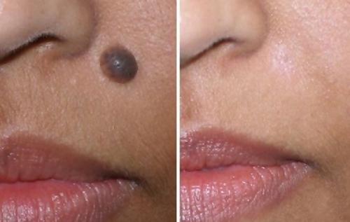 Trị mụn ruồi xấu xí với công thức đơn giản chưa đến 2 ngàn đồng-5