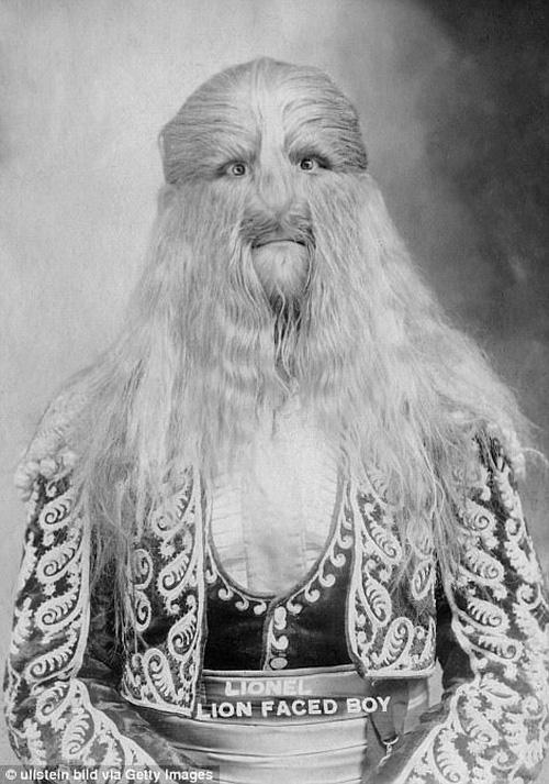 Cuộc sống trưng bày trong gánh xiếc của những người bị dị tật bẩm sinh ở thế kỷ 19-2