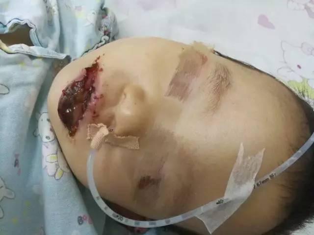 Bé gái 2 tuổi bị bỏng toàn bộ miệng vì ăn nhầm gói tẩy lồng máy giặt-1