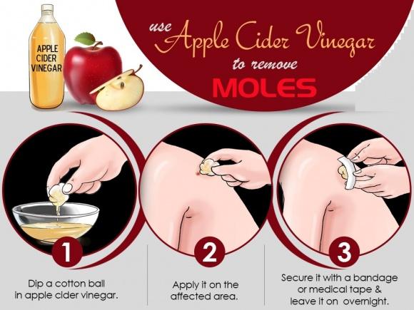 Lấy một nhánh tỏi khô làm theo cách sau, cần gì tốn bạc triệu đi spa tẩy nốt ruồi-2