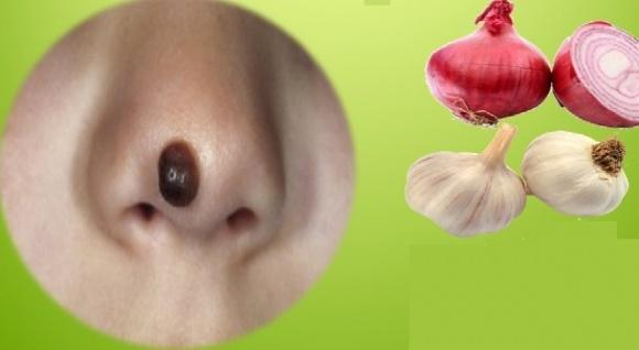 Lấy một nhánh tỏi khô làm theo cách sau, cần gì tốn bạc triệu đi spa tẩy nốt ruồi-5