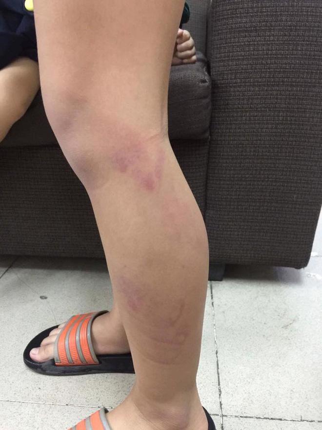 Hà Nội: Vào lớp muộn, học sinh tiểu học bị cô giáo đánh tím tái hai chân đến gãy thước?-1