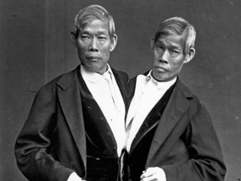 Cặp song sinh liền thân xinh đẹp nhất thế giới, kết hôn với hai ông chồng nhưng đến chết vẫn là trinh nữ-11