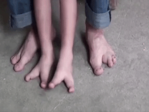 Khoảnh khắc bé trai 5 tuổi có bàn chân kỳ lạ bước đi khiến ai cũng xót xa