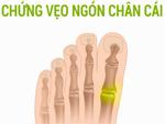 Cách ngăn ngừa chứng vẹo ngón chân cái