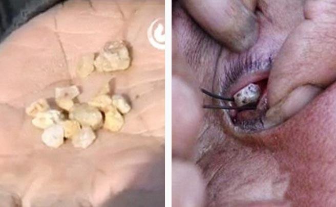 Không hiểu mắc phải bệnh gì, bé gái ngày nào cũng khóc ra bông-2