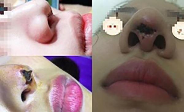 Những ca phẫu thuật thẩm mỹ khiến bệnh nhân biến dạng gây rúng động mạng xã hội-5