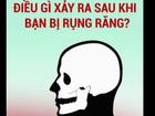 Điều gì xảy ra sau khi bạn bị rụng răng?