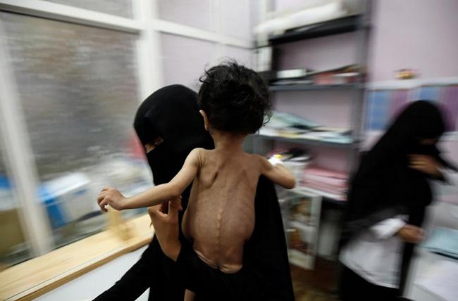 Cậu bé da bọc xương thoi thóp chờ chết gây chấn động thế giới 1 năm trước giờ ra sao?-3