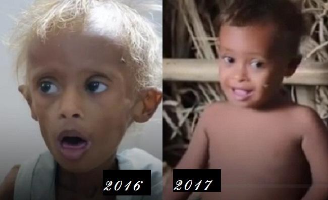 Cậu bé da bọc xương thoi thóp chờ chết gây chấn động thế giới 1 năm trước giờ ra sao?-5