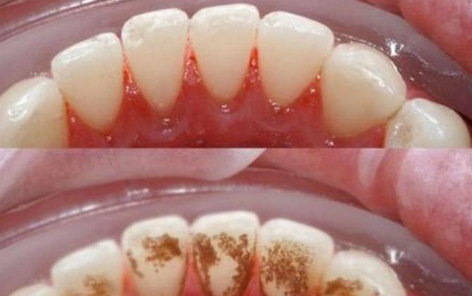 Cao răng dày đến mấy cũng tự bật ra từng mảng, hôi miệng cỡ nào cũng hết chỉ với 1.000 đồng-1