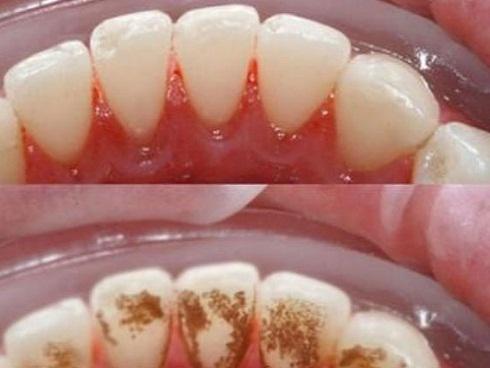 Cao răng dày đến mấy cũng tự bật ra từng mảng, hôi miệng cỡ nào cũng hết chỉ với 1.000 đồng