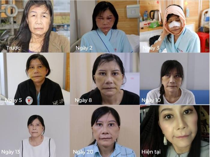 22 tuổi mà bị lão hóa như cụ bà 80, cô gái lột xác nhờ phẫu thuật thẩm mỹ-1