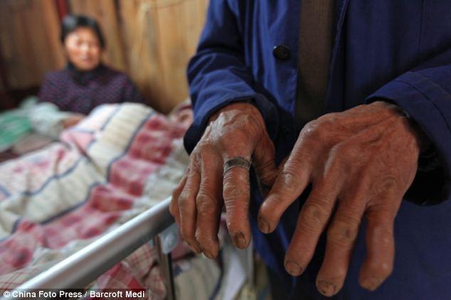 Bố mẹ ngày đêm bóp bóng thở suốt 5 năm trời giúp con duy trì sự sống, dừng lại 3 phút con sẽ chết-5