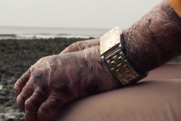 Những người mắc bệnh lạ đến y học cũng phải bó tay chữa không nổi-2