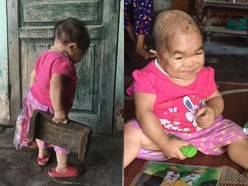 Kỳ lạ người phụ nữ 27 tuổi mang hình hài 'trẻ lên 2' ở Thái Nguyên