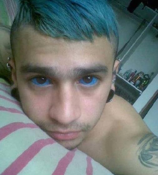 Đú đởn xăm nhãn cầu, cô gái trẻ khóc uất nghẹn vì biến chứng mù mắt-1