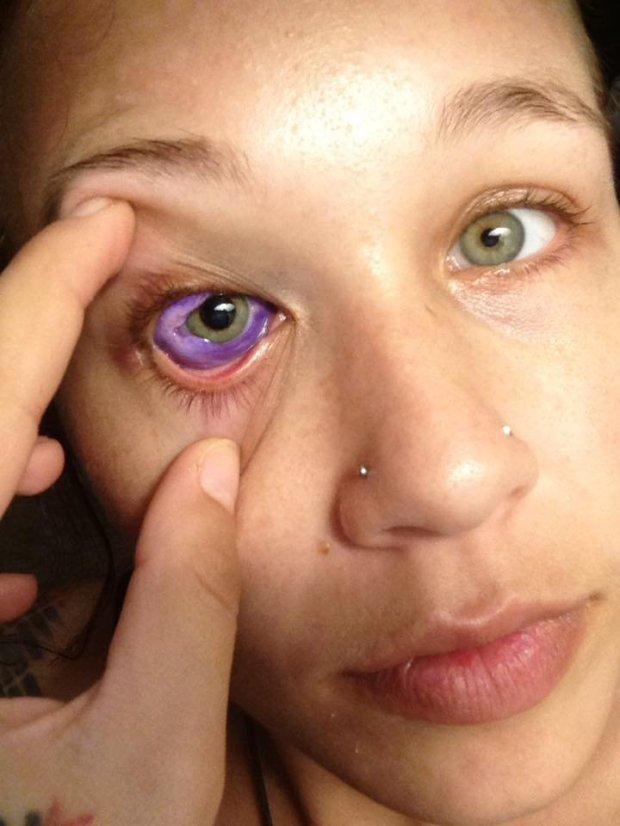 Đú đởn xăm nhãn cầu, cô gái trẻ khóc uất nghẹn vì biến chứng mù mắt-2