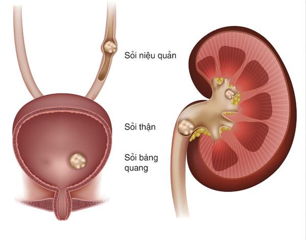 Những biến chứng nguy hiểm của sỏi thận-1