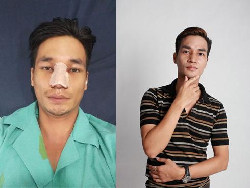 Chán mặt đơ như tượng sáp, Lệ Rơi tháo sụn mũi để trở về diện mạo 'nguyên bản'